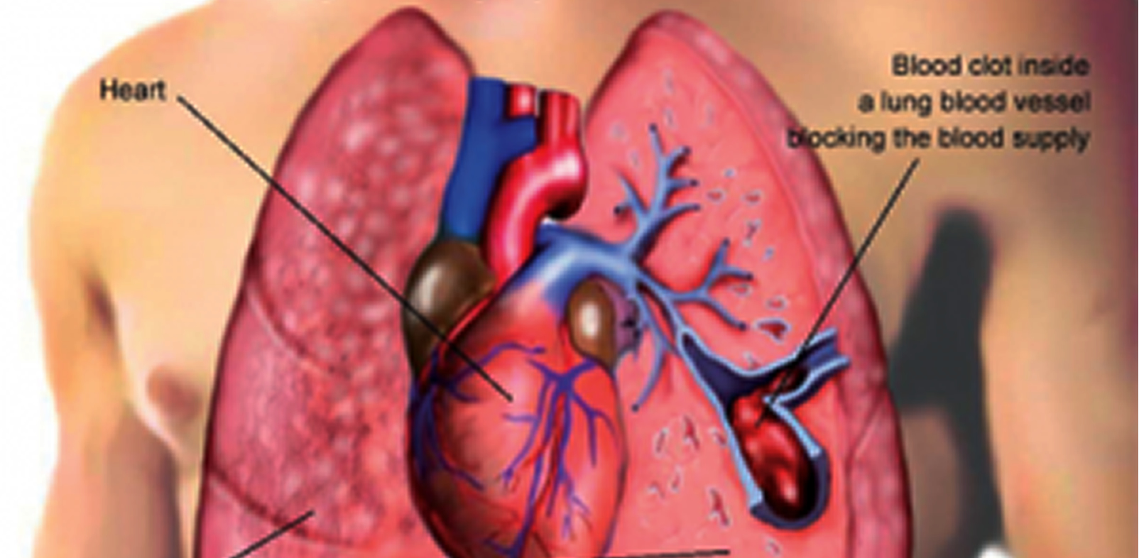 large pulmonary embolism